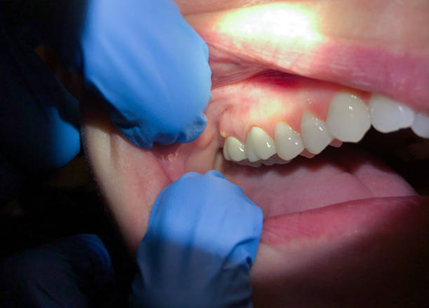 Urgent Tooth Repair in PA